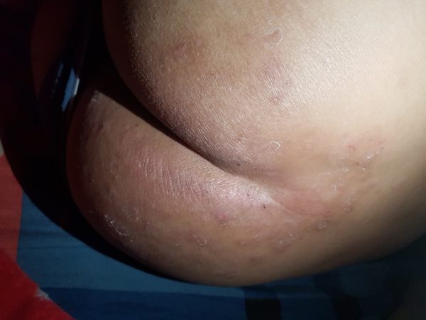 eczema-viem-da-co-dia-15-nam-da-phuc-hoi-80-chi-sau-1-thang-nho-bi-kip-nay-1