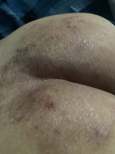 eczema-viem-da-co-dia-15-nam-da-phuc-hoi-80-chi-sau-1-thang-nho-bi-kip-nay-2