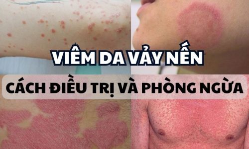 viem-da-vay-nen-hieu-nguyen-nhan-de-co-cach-dieu-tri-va-phong-ngua-hop-ly-1