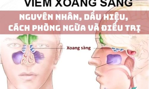 viem-xoang-sang-nguyen-nhan-dau-hieu-va-cach-dieu-tri-1