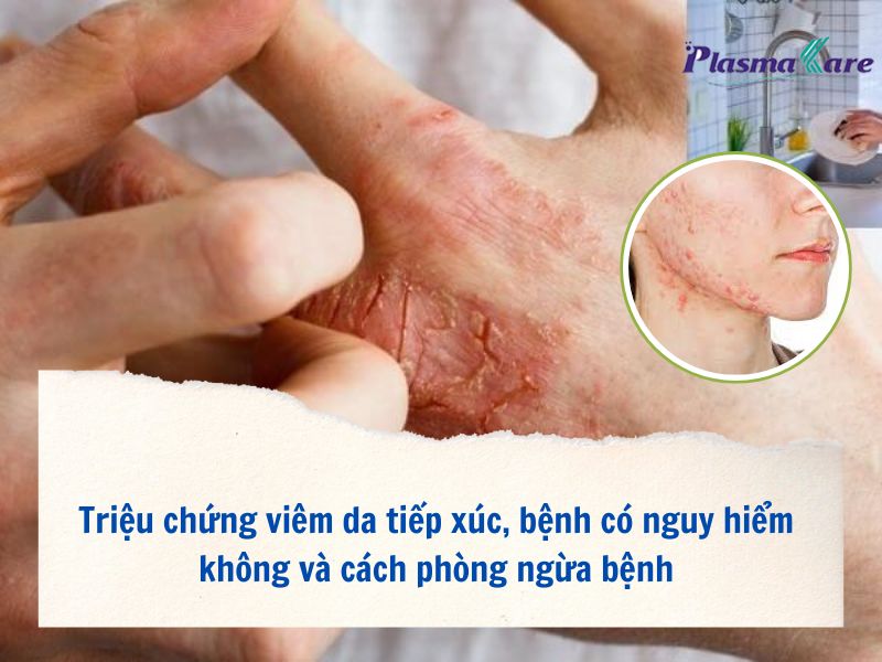 trieu-chung-viem-da-tiep-xuc-benh-co-nguy-hiem-khong-va-cach-phong-ngua-benh-1