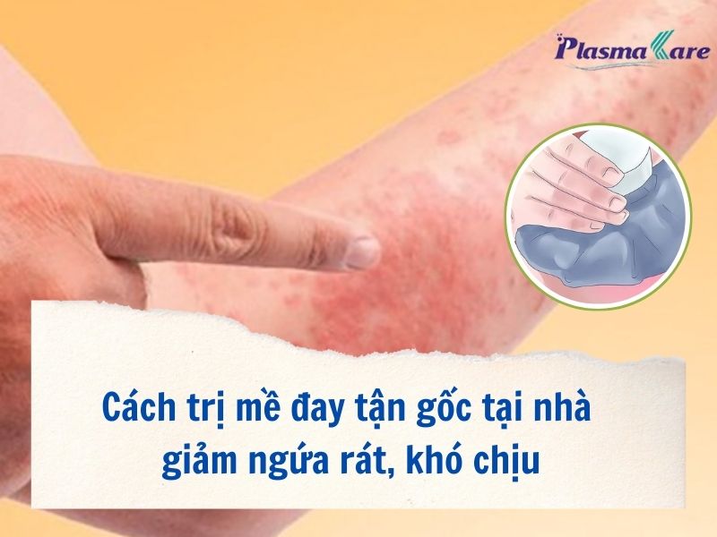 Cách trị mề đay tận gốc: Giải pháp hiệu quả và an toàn