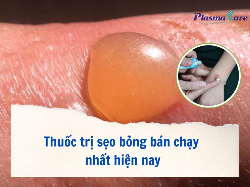 thuoc-tri-seo-bong-ban-chay-nhat-hien-nay-1