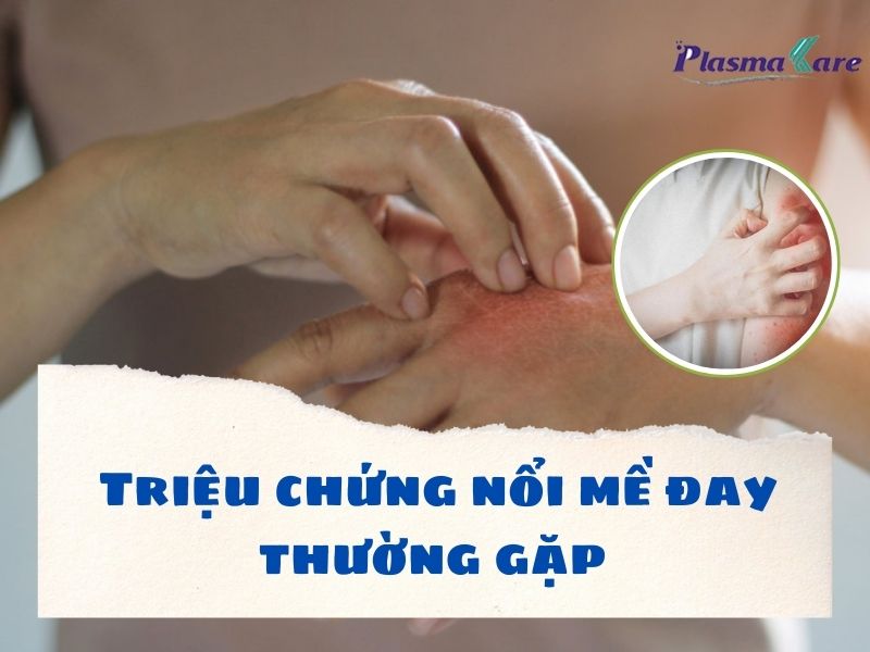 trieu-chung-noi-me-day-thuong-gap-1