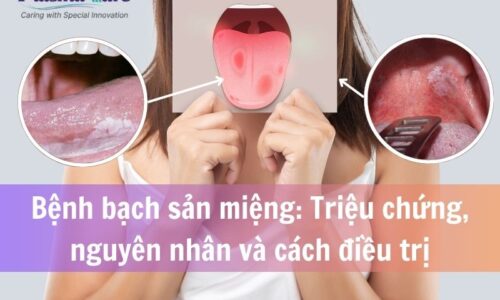 Bạch sản miệng triệu chứng nguyên nhân và cách điều trị