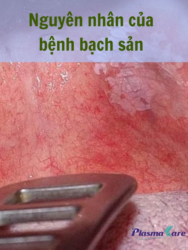nguyen-nhan-cua-benh-bach-san-1