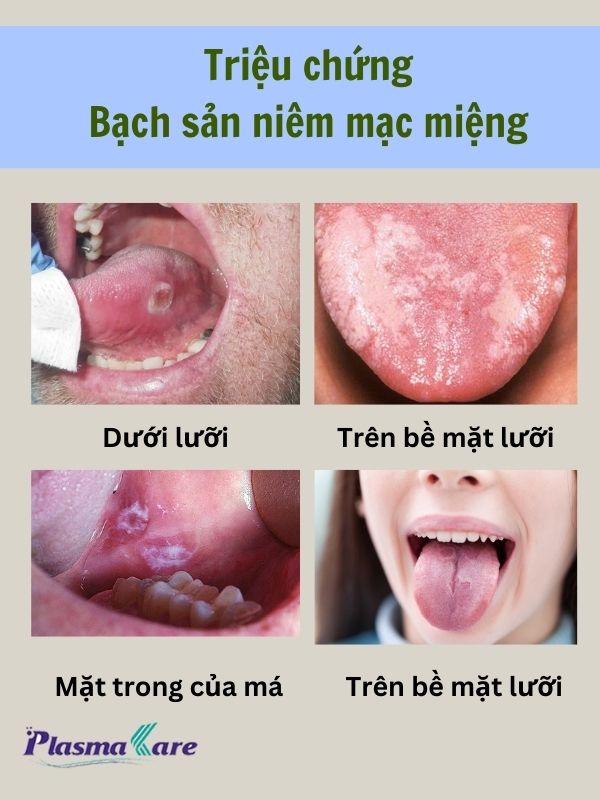 Triệu chứng bạch sản niêm mạc miệng