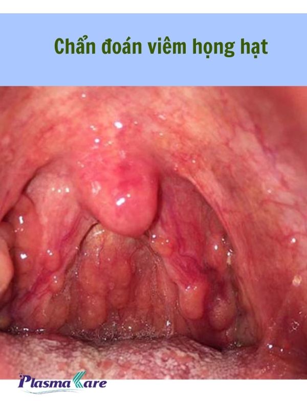 Chẩn đoán viêm họng hạt