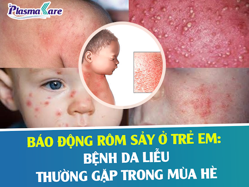 bao-dong-rom-say-o-tre-em-benh-da-lieu-thuong-gap-trong-mua-he