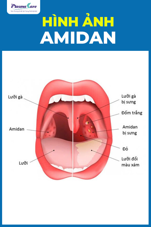 viem-amidan-co-lay-khong-cach-phong-benh-hieu-qua-1