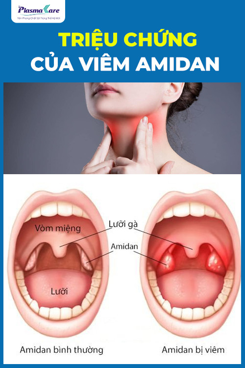 viem-amidan-co-lay-khong-cach-phong-benh-hieu-qua-3