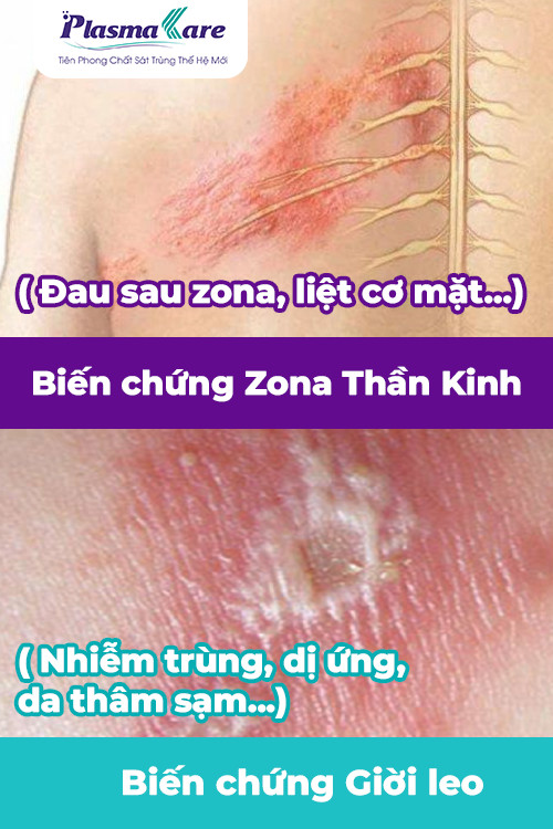 cach-phan-biet-zona-than-kinh-va-gioi-leo-3