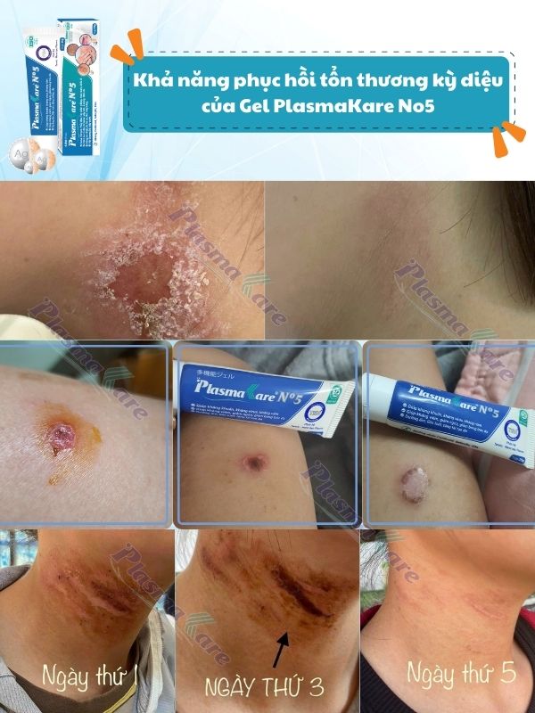 review-gel-boi-lam-lanh-va-phuc-hoi-ton-thuong-da-than-toc-plasmakare-no5-6