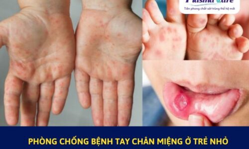 6-bien-phap-phong-chong-benh-tay-chan-mieng-o-tre-nho-1