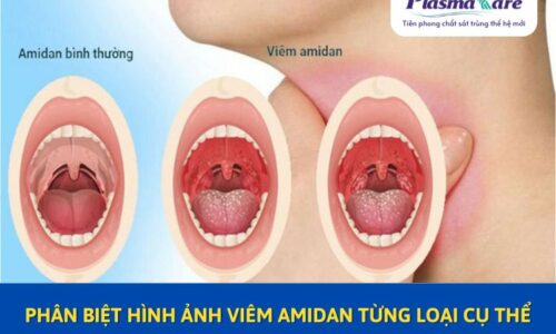 phan-biet-hinh-anh-viem-amidan-tung-loai-cu-the-1