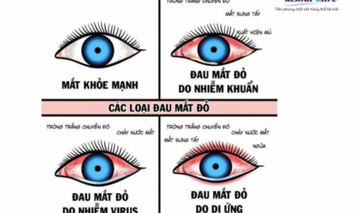 phong-ngua-benh-dau-mat-do