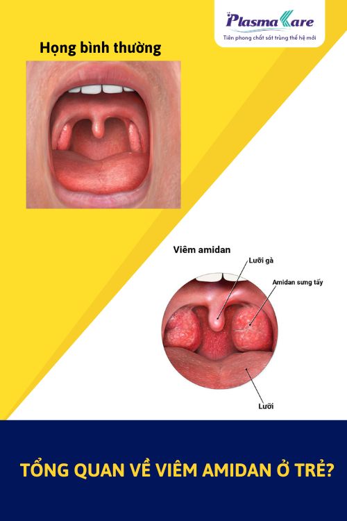 trieu-chung-viem-amidan-o-tre-2