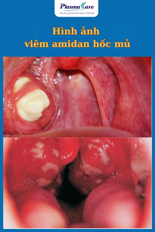 viem-amidan-hoc-mu-co-nen-cat-khong-khi-nao-nen-thuc-hien-phau-thuat-1