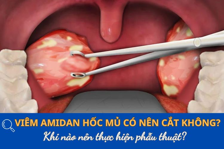 viem-amidan-hoc-mu-co-nen-cat-khong-khi-nao-nen-thuc-hien-phau-thuat