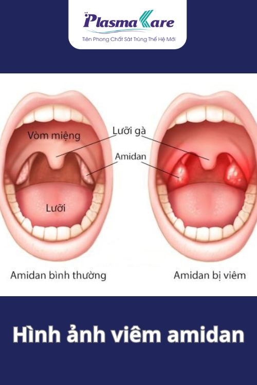 viem-amidan-uong-thuoc-khong-khoi-phai-lam-sao-1