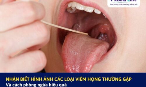 Nhận biết hình ảnh các loại viêm họng và cách phòng ngừa hiệu quả tại nhà