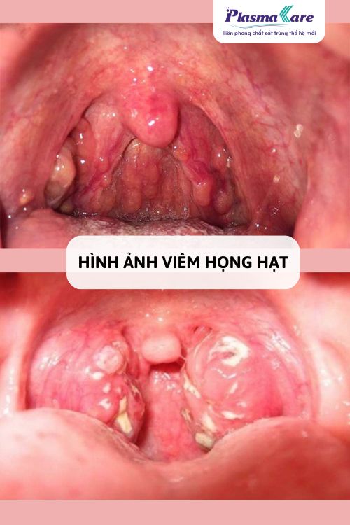 viem-hong-hat-bao-lau-thi-khoi-2