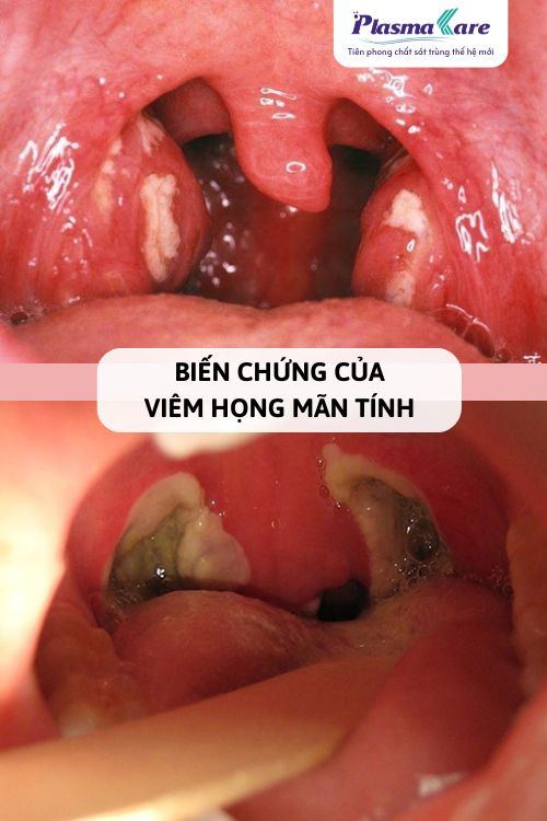 viem-hong-man-tinh-4