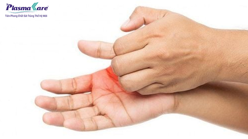Không gãi hoặc nặn mụn nước
