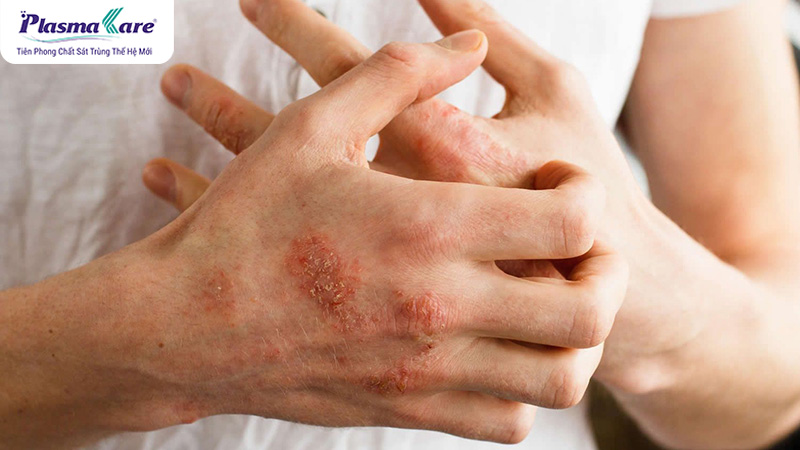 Bạn tuyệt đối không được gãi hoặc tự ý nặn mụn nước xuất hiện trên da
