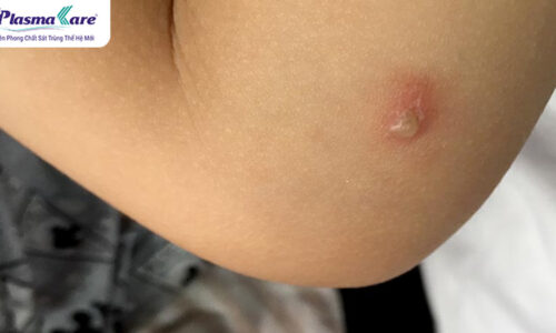 Cách điều trị kiến ba khoang cắn nhanh nhất tại nhà