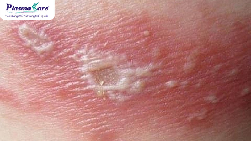 Hình thành mụn nước hoặc phỏng nước