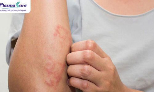 vết kiến ba khoang cắn