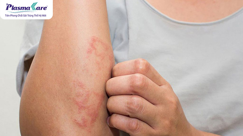 vết kiến ba khoang cắn