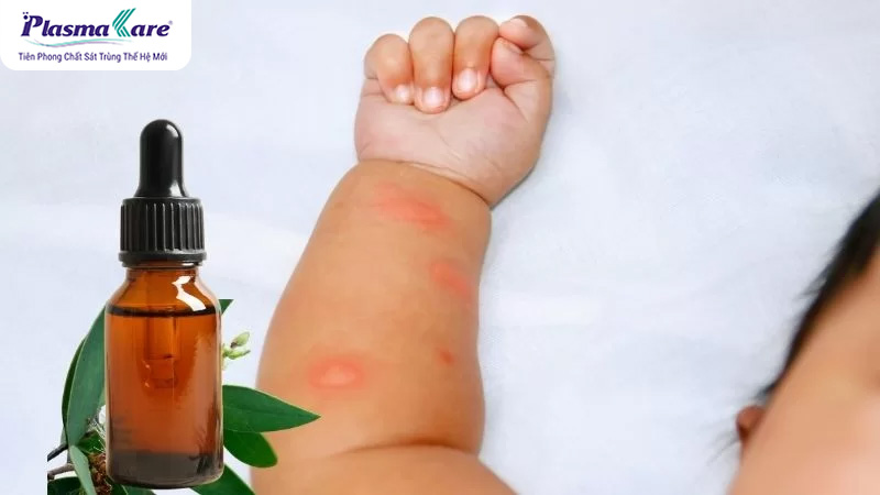 Bé bị muỗi đốt bôi dầu tràm được không?