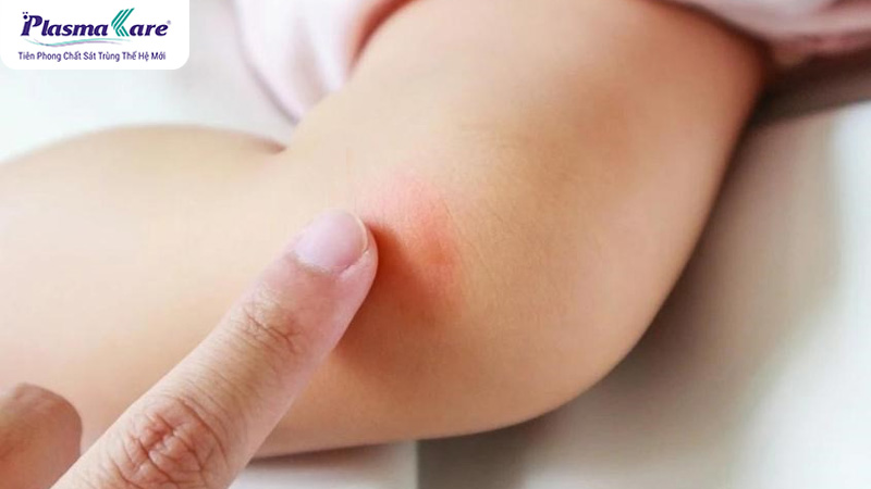 Bé bị muỗi đốt bôi dầu tràm được không?