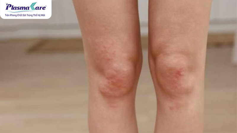 Bị muỗi đốt nhiều có sao không? Nguyên nhân bị muỗi đốt nhiều