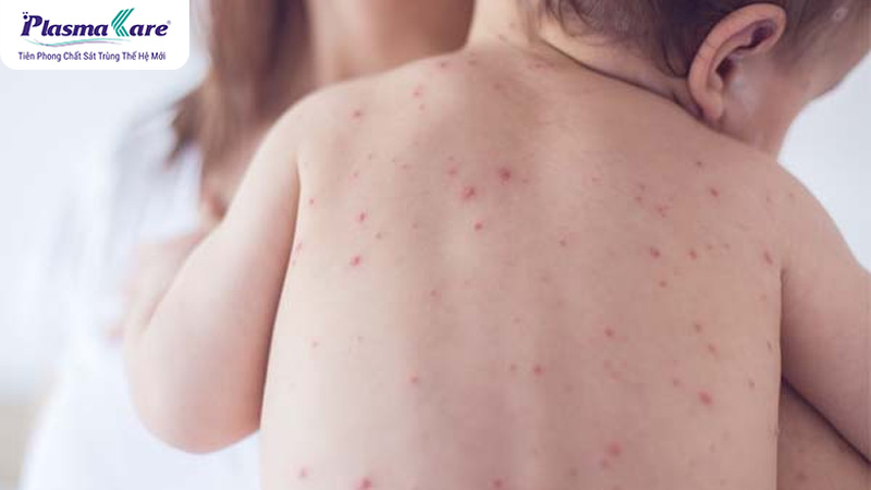 Bị muỗi đốt nhiều có sao không? Nguyên nhân bị muỗi đốt nhiều