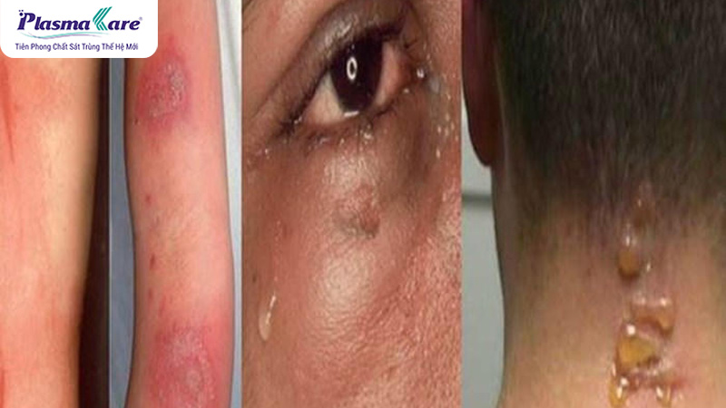 Cách xử lý khi bị kiến độc cắn