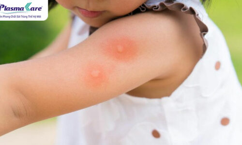 Lý do muỗi đốt để lại chấm đỏ không ngứa và cách làm tan vết đỏ