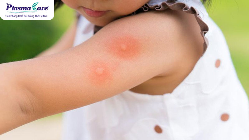 Lý do muỗi đốt để lại chấm đỏ không ngứa và cách làm tan vết đỏ