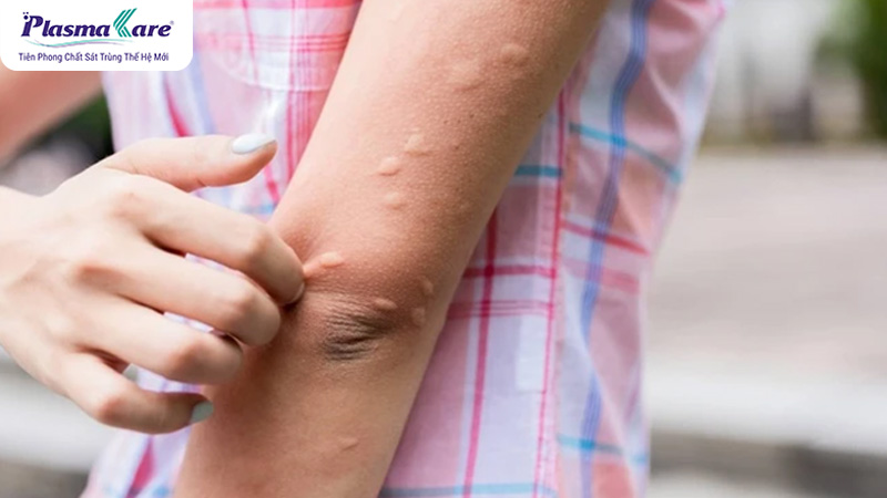 Nguyên nhân muỗi đốt sưng to và cách giảm sưng hiệu quả