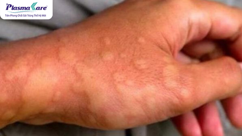Nguyên nhân muỗi đốt sưng to và cách giảm sưng hiệu quả