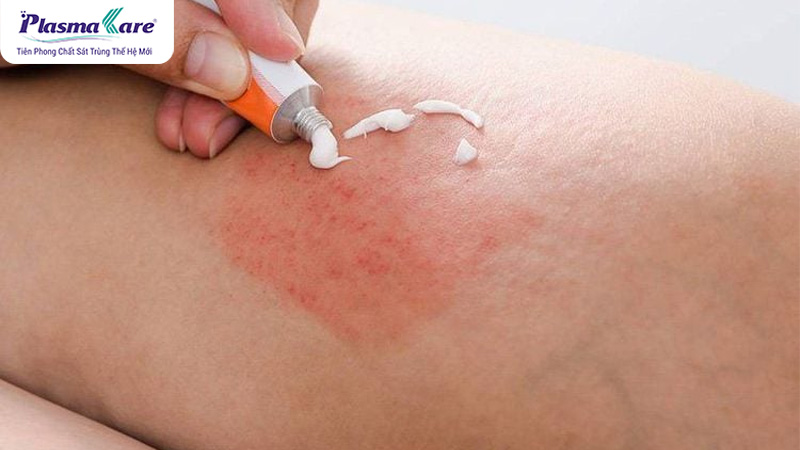 Nguyên nhân muỗi đốt sưng to và cách giảm sưng hiệu quả