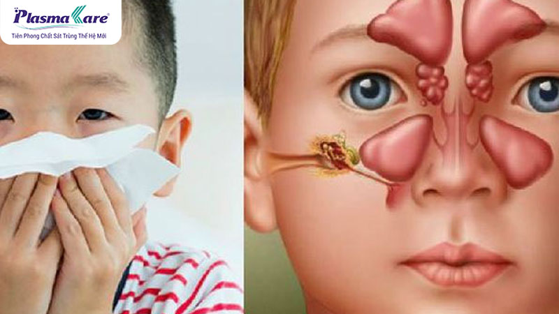 Trẻ bị viêm xoang thường có triệu chứng nghẹt mũi nhiều, thở khò khè, khó ngủ và dễ thức giấc vào ban đêm.