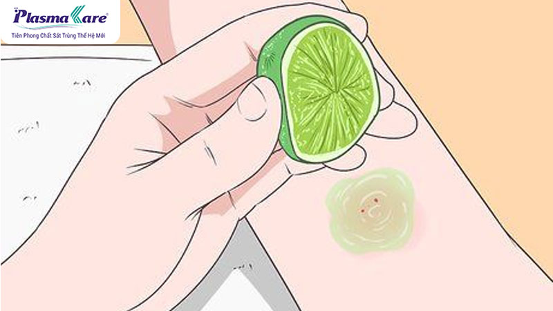 Cách hết ngứa khi bị muỗi đốt hiệu quả nhanh nhất