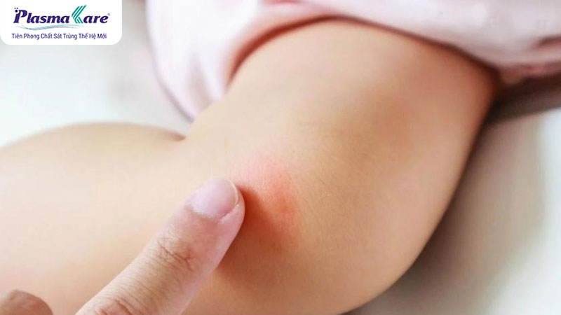 Cách hết ngứa khi bị muỗi đốt hiệu quả nhanh nhất