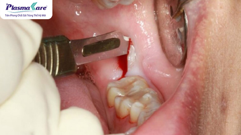 Cắt lợi trùm là gì? Có nên cắt lợi trùm không?