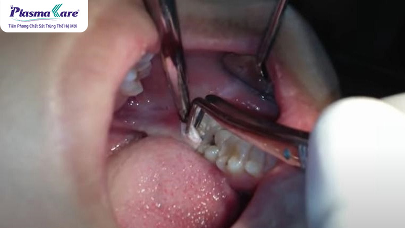 Cắt lợi trùm là gì? Có nên cắt lợi trùm không?