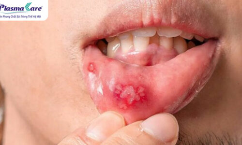 Hay bị nhiệt miệng là dấu hiệu của bệnh gì?