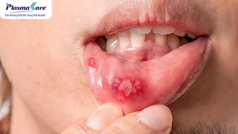 Hay bị nhiệt miệng là dấu hiệu của bệnh gì?